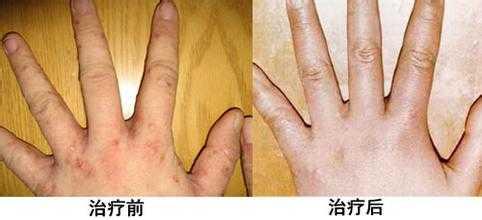 治疗湿疹最好的医院在哪_地址_电话,重庆皮肤科医院